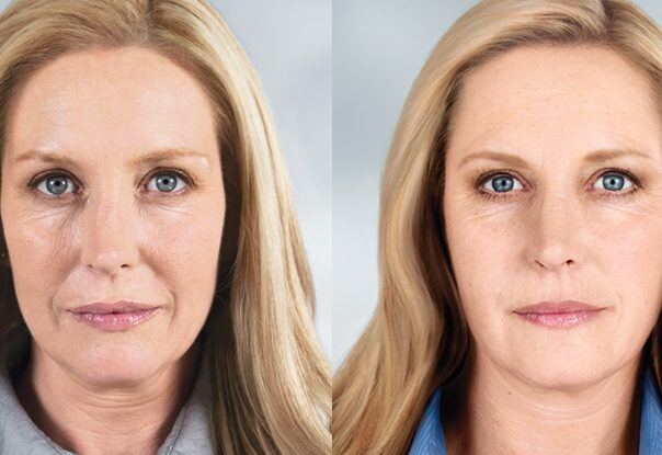 Unveiling Full Face Sculptra Before And After Masterpieces