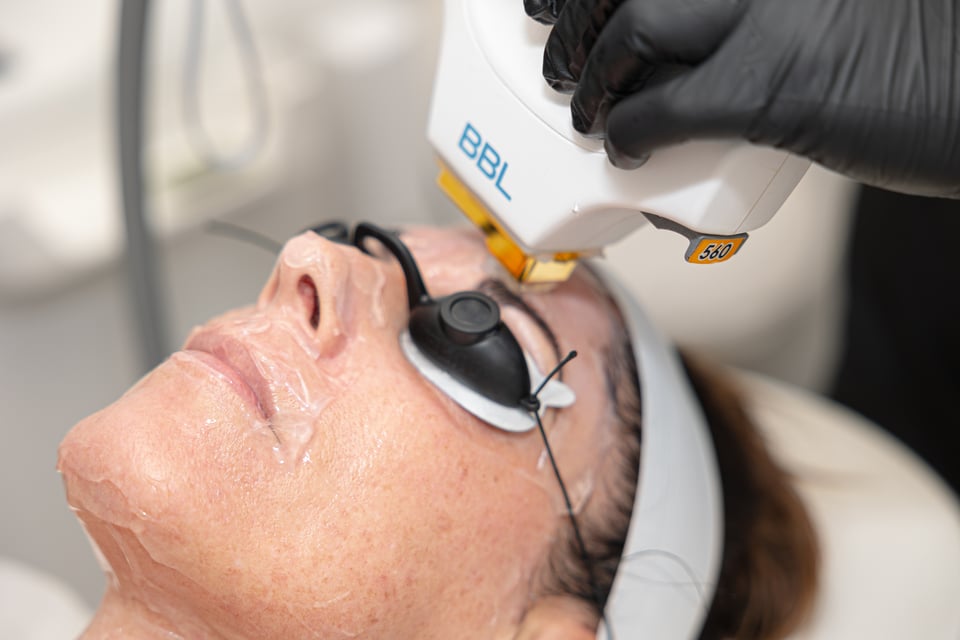 BBL Laser for Broken Capillaries: What You Need to Know!