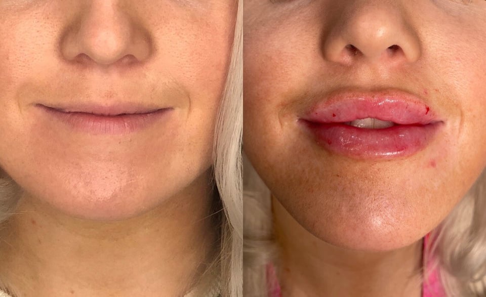 Understanding The Difference Between Lip Flip And Lip Filler