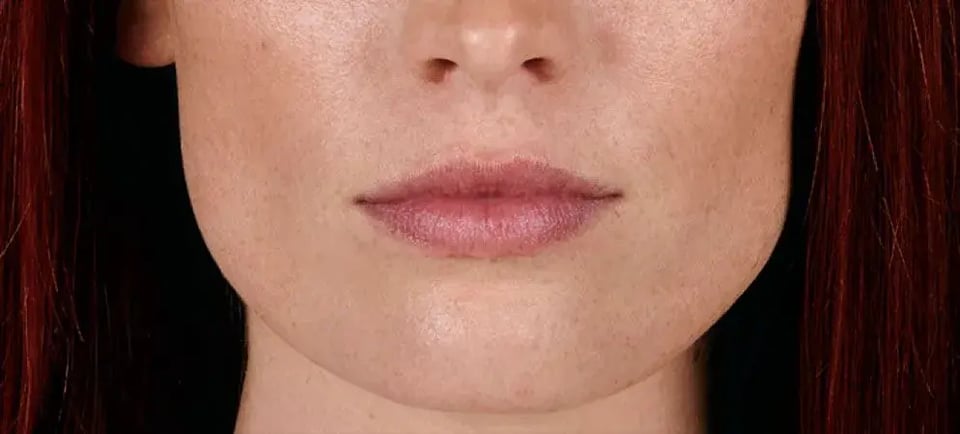 Choosing the Best Filler for Jawline Enhancement