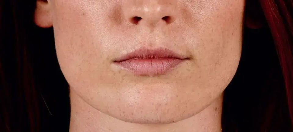 Unveiling The Benefits Of Biostimulatory Fillers