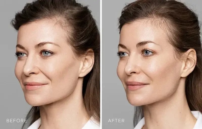 Is Sculptra Worth It? Expert Insights Revealed