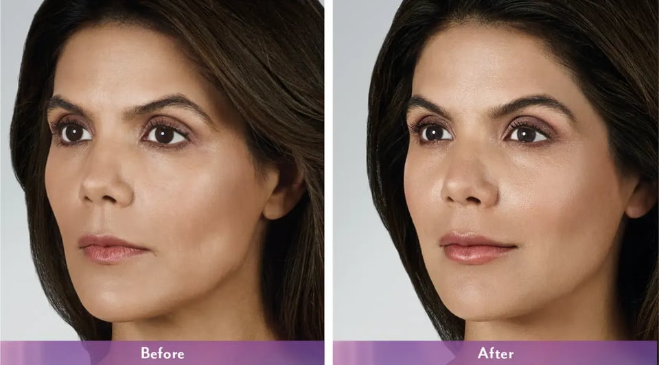 Stunning Cheek Filler Before And After Transformations