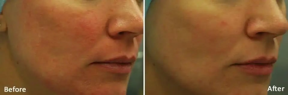 Vivace Vs Morpheus8 Skin Tightening Comparison