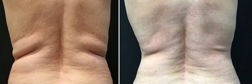 CoolSculpting Flanks Before and After Comparison