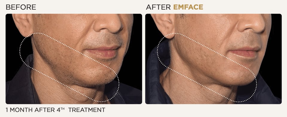 How To Manage Chin Filler Bruising And Swelling?