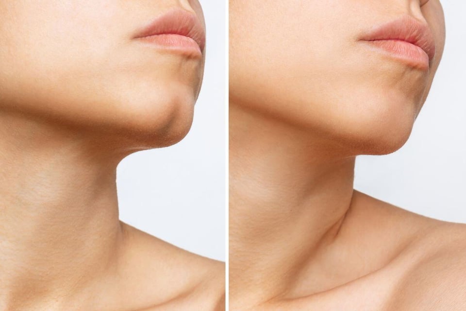 Cleft Chin Filler Cost: Understanding Pricing Factors